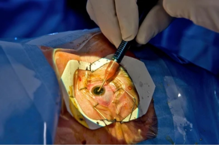 Cataract Surgery