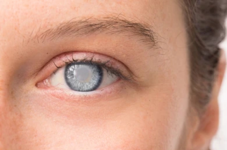 Cataracts-----15