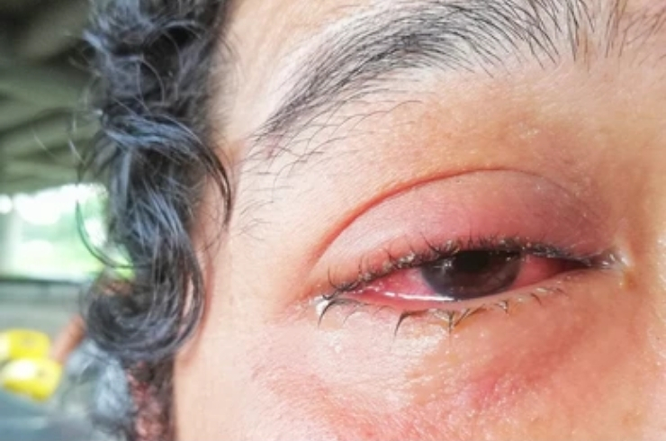 conjunctivitis