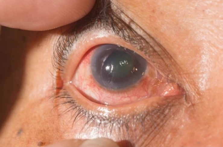Glaucoma-
