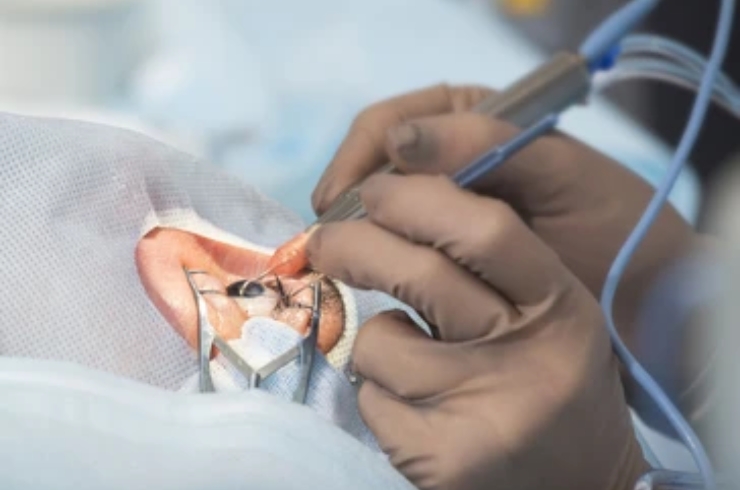 Phaco Surgery